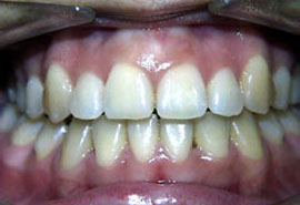 After Braces to correct crowded teeth